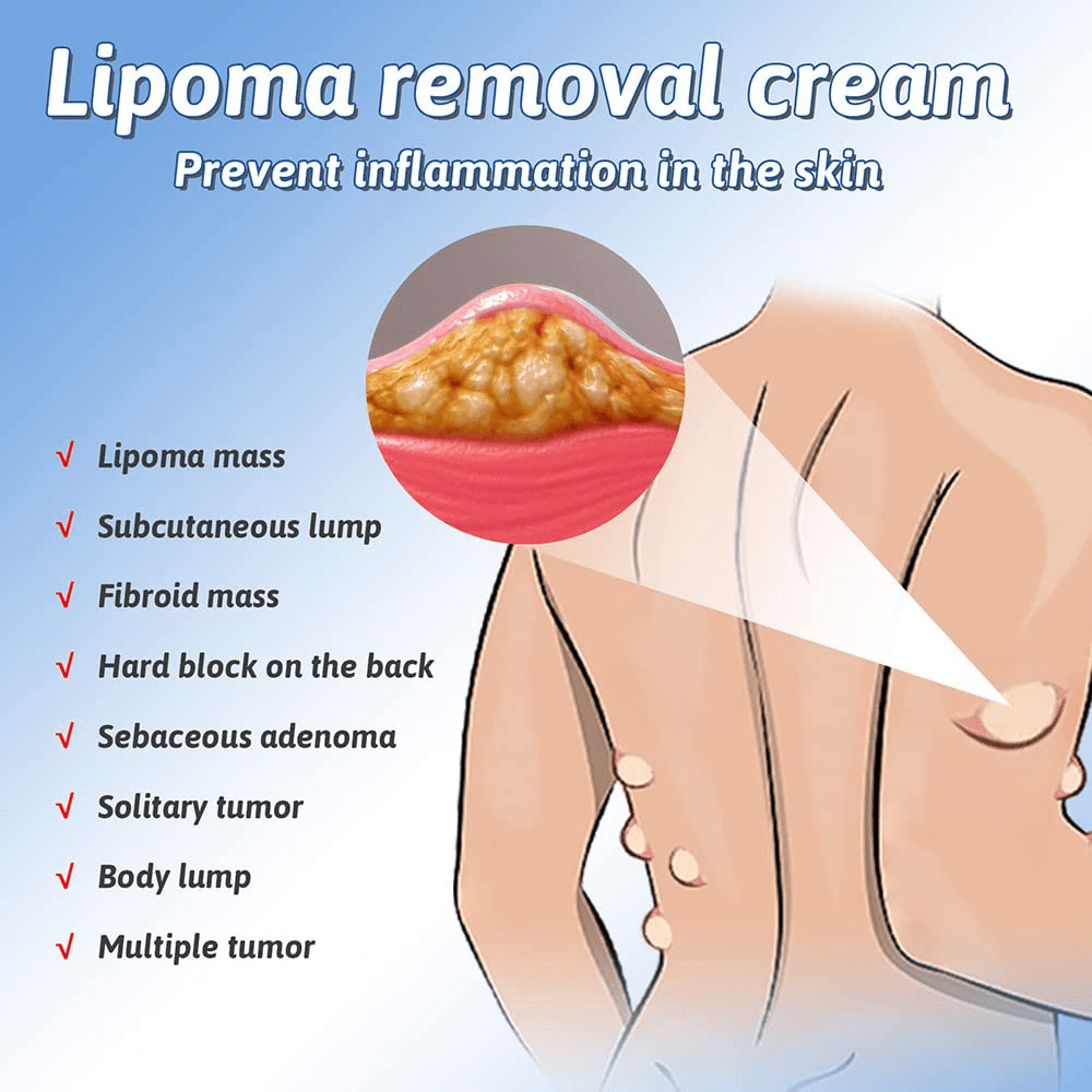 SS Herbal Lipoma Removal Cream (50gm)